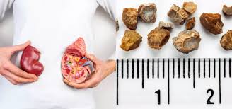 Top 9 Food Changes That Can Help Prevent Kidney Stones Parhlo Com