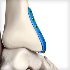 The medial malleolus is an anatomical region of the tibia. Malleolar Hook Plates Unite Foot And Ankle
