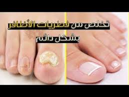 فطريات الاظافر الحل النهائي لعلاجها Youtube Beauty Care Nails Beauty
