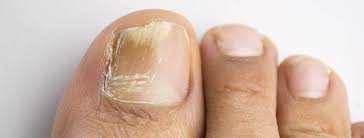 He preguntado a mucha gente del ámbito sanitario, pero nadie ha sabido recomendarme una ruta a seguir. Onicomicosis Hongos En Las Unas Esalud Com