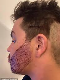 Bobby Norris: TOWIE star shares results of his beard transplant