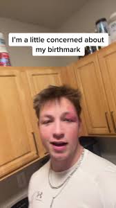 Understanding Port Wine Stains and Laser Treatment for Birthmarks