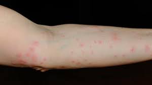 Image result for spinne biss haut reaktion