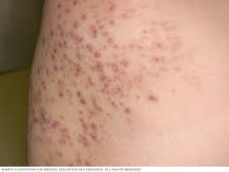 Hello, folliculitis is common after hair removal.after laser hair removal, apply cold compresses(ice cubes wrapped in a towel) on the rash and take some antihistaminic like benadryl or claritin.you can also apply calamine lotion on the rash.it will help in soothing the skin. St Elizabeth Healthcare Condition