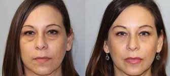 Facial Plastic Surgeon Orange County