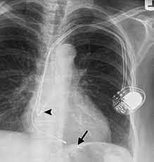 Pertinent factors relating to each manufacturer's devices are referenced according to: Radiography Of Cardiac Conduction Devices A Comprehensive Review Radiographics