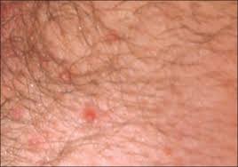 Hpv is a different virus than hiv and hsv (herpes). Are These Asymptomatic Bumps Genital Warts Infectious Diseases