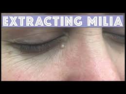 Image result for milium cyst on eyelid