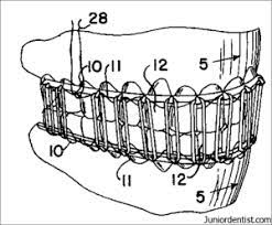 Check spelling or type a new query. Types Of Dental Splints Fixed And Removable Dental Splints