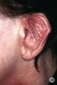 Image result for Relapsing Polychondritis