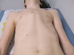 It can either be present at birth or develop after puberty. Pectus Program Prisma Health Upstate Childrens
