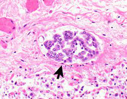Check spelling or type a new query. Pathology Outlines Diffuse Malignant Mesothelioma