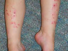 Arthropod Bites And Stings Dermnet Nz