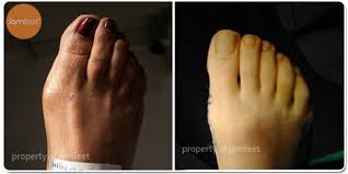 After surgery for a broken toe, i left with a surgical shoe with open toes. Before After Bunion Surgery Photo Gallery Los Angeles Foot Doctor Beverly Hills