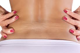 In order for these treatments to work, though, you'll have to stick it out for a while. How To Get Rid Of Stretch Marks Home Treatment Prevention