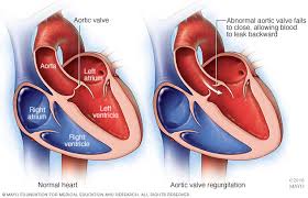Aortic Valve Regurgitation Symptoms And Causes Mayo Clinic Aortic Valve Replacement Heart Surgery Surgery