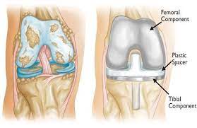 What Is The Success Rate Of Knee Replacement In India Vaidam Com
