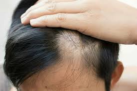 However, it can also affect other parts of the body. How To Cover Or Completely Get Rid Of Bald Spots