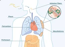 By stage iv, advanced metastatic cancer patients can have a larger effect on organs and likely to produce more symptoms, such as fatigue, pain, and weight loss. Malignant Mesothelioma What To Do After You Re Diagnosed