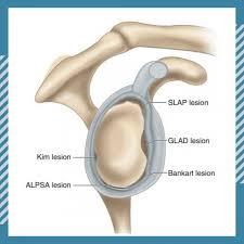 Image result for SLAP Lesion