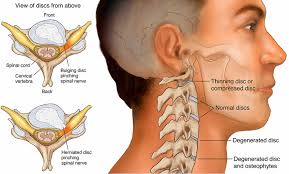 Check spelling or type a new query. Cervical Radiculopathy Causes Symptoms Diagnosis Treatment