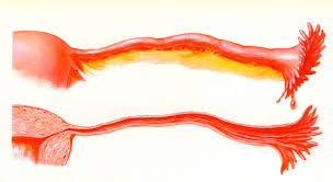 TROMPAS UTERINAS
