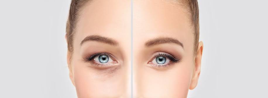 Blépharoplastie ou chirurgie des paupières à Paris - Dr Franchi