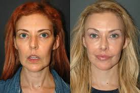 Andrew Jacono, MD-The New York Center for Facial Plastic and Laser Surgery 