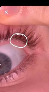 Bei einem inneren gerstenkorn kann oft nur der geübte blick eines augenarztes eine genaue diagnose stellen. Gerstenkorn Gesundheit Und Medizin
