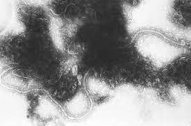 The virus presents as a cold and can leave children very short of breath, or even develop into pneumonia. Respiratory Syncytial Virus Wikipedia