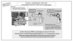 Image result for Elson Extensor Tendon Test