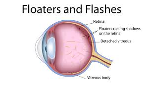 Image result for Floaters