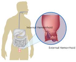 Image result for Hemorrhoid