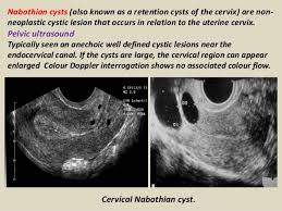 Nabothian Cyst Ultrasound Sonography Sonography Ultrasound