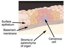 The rarity of adrenocortical carcinoma means that the potential opportunities to perform adequate clinical study. Carcinoma In Situ Wikipedia