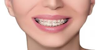 Blog Archives Elrod Orthodontics Ceramic Braces Metal Braces Clear Braces Vs Metal