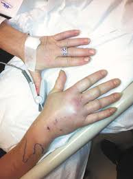 A cat will care for its own nails if you provide it with a scratching post. Cat Bite Nearly Costs Palmer Woman Her Arm Local News Stories Frontiersman Com