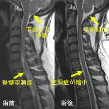 小脑扁桃体下疝 脊髓空洞症 强直性脊柱炎 脊髓脊椎损伤 腰骶皮毛窦 脊髓炎 脊柱退行性疾病. æ±äº¬å¤§å­¦åŒ»å­¦éƒ¨è„³ç¥žçµŒå¤–ç§' è„Šæ¤Ž è„Šé«„ç–¾æ‚£