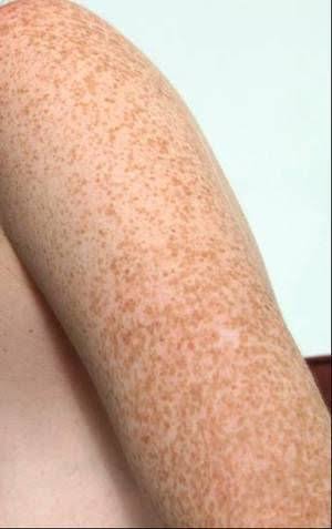 Mga resulta ng larawan para sa Freckles on the arm"