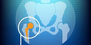 Doresc sa multumesc domnului dr. Proteza De Sold Ce Presupune Operatia De Protezare A Soldului