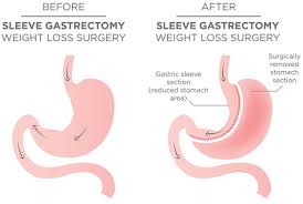 Sleeve Gastrectomy Surgery Explained Central Coast Surgery