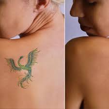 Before and after pictures of an actual patient who received a laser tattoo removal treatment at south coast medspa. Safe Laser Tattoo Removal In Huntington Ny Picosure Treatment Dr Roger Koreen