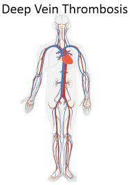 Deep Vein Thrombosis Dvt Causes Prevention Eruptingmind
