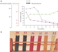 Image result for G6PD Deficiency Detection