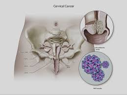 Cervical cancer presents a special challenge because you may not notice any signs or symptoms, especially when the condition is in its earliest stages. Cervical Cancer Facts Symptoms Treatment Osuccc James
