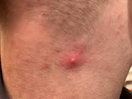 An ingrown hair forms when a hair follicle becomes trapped under the skin, causing inflammation and irritation. Okay What The Hell Is This It Will Not Pop Whatsoever Could It Be An Ingrown Hair Popping