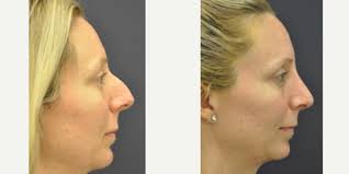 Mark Been, MD, Board Certified Facial Plastic Surgeon