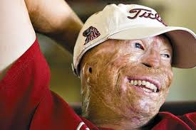 Burn Victim 1 Extraordinary Cases Of People Who Survived Deadly Fires Pictures Seen On Www Vyperlook Com Burn Survivor People Burns