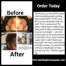 Formula d hair regrowth serum is a 100% natural chemical free fast hair growth serum that contains essential oils. Extra Strength Formula D Hair Growth Oil With Amla Coconut Oil Jbco For Receding Hairline Dht Blocker Men Or Women Alopecia