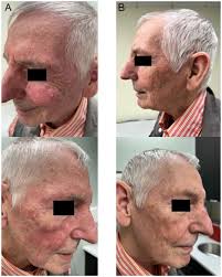 A Review of the Dermatologic Clinical Applications of Topical Photodynamic  Therapy